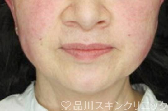 症例NO.74473のAFTER写真