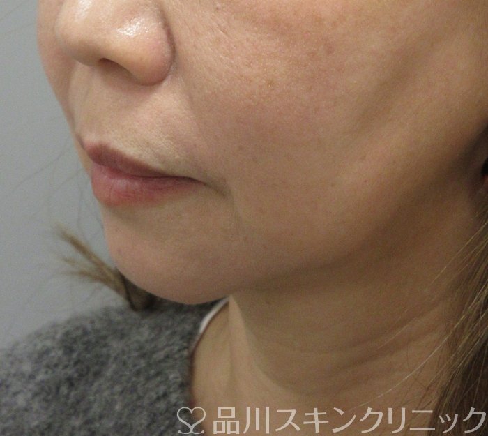 症例NO.74838のBEFORE写真