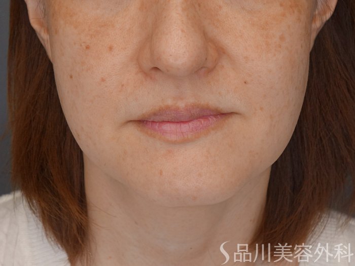症例NO.71954のBEFORE写真
