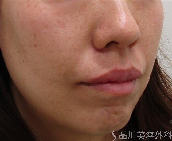 症例NO.43081のBEFORE写真