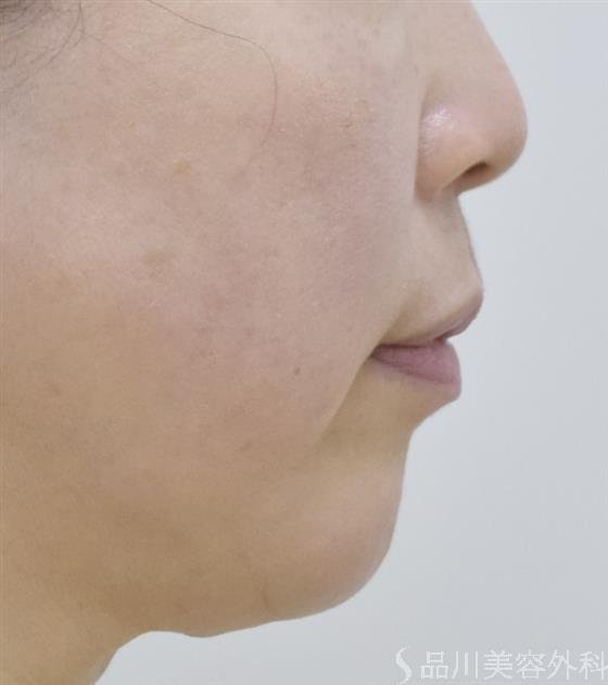 症例NO.51474のBEFORE写真