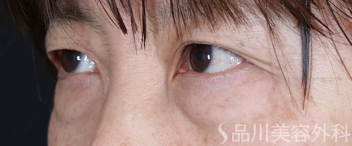 症例NO.71400のBEFORE写真