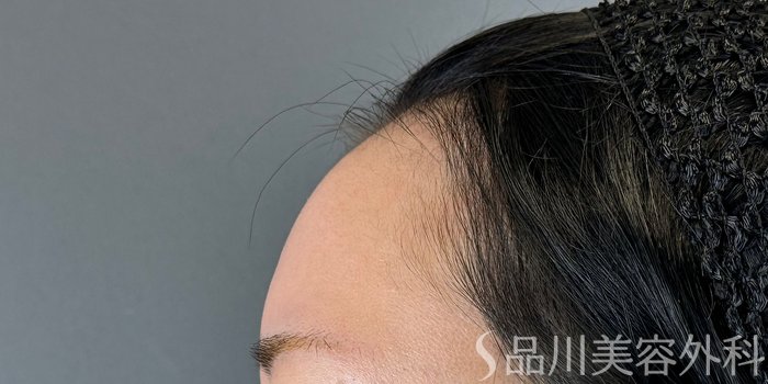 症例NO.73138のBEFORE写真