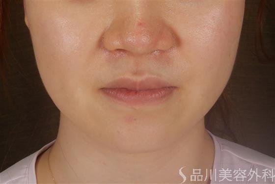 症例NO.59724のAFTER写真