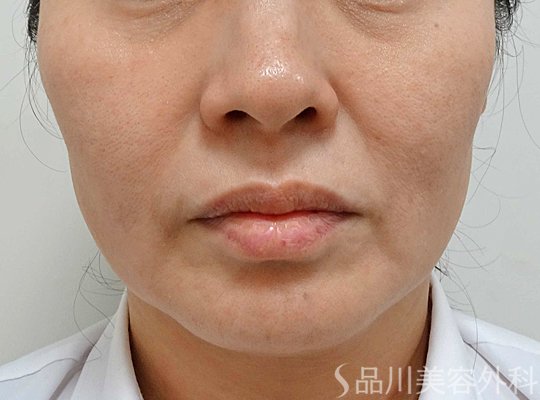 症例NO.67370のBEFORE写真
