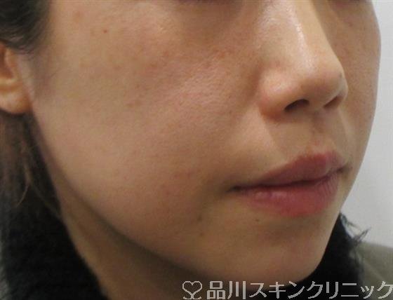 症例NO.26725のBEFORE写真