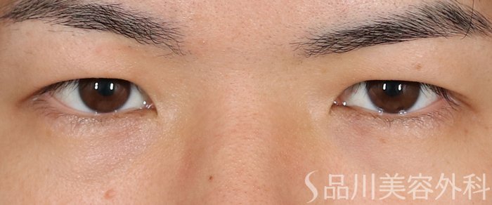 症例NO.71062のBEFORE写真
