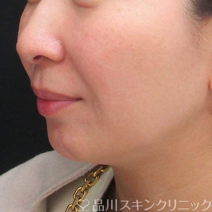 症例NO.73414のBEFORE写真