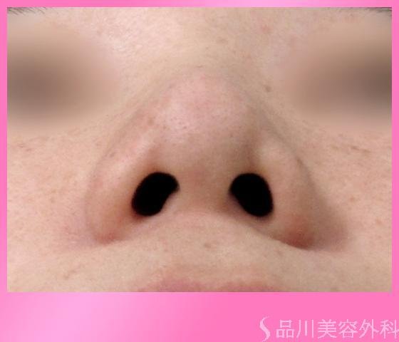 症例NO.2086のBEFORE写真