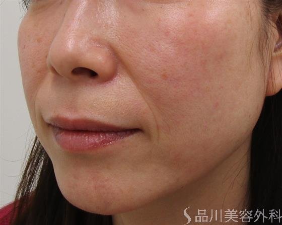 症例NO.44028のBEFORE写真