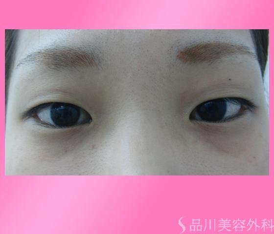 症例NO.2533のBEFORE写真