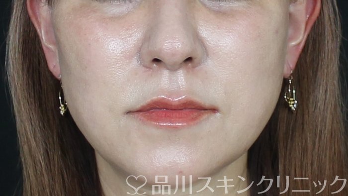 症例NO.71199のAFTER写真