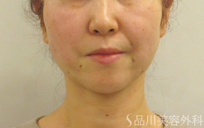 症例NO.73231のAFTER写真