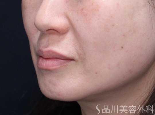 症例NO.73034のBEFORE写真