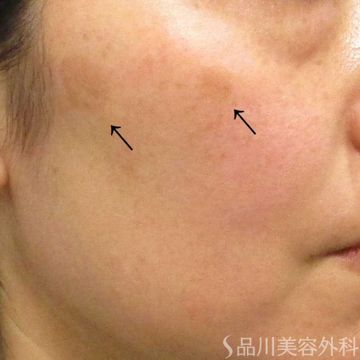 症例NO.67582のBEFORE写真