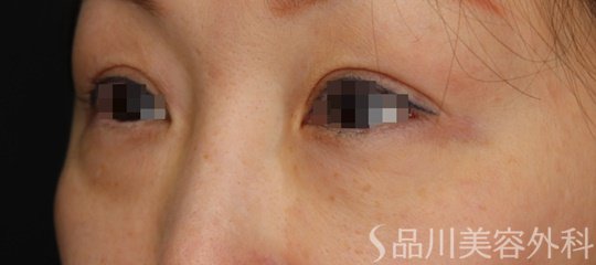 症例NO.64281のBEFORE写真