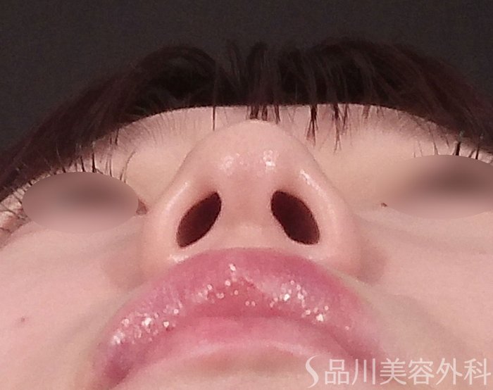 症例NO.69294のAFTER写真