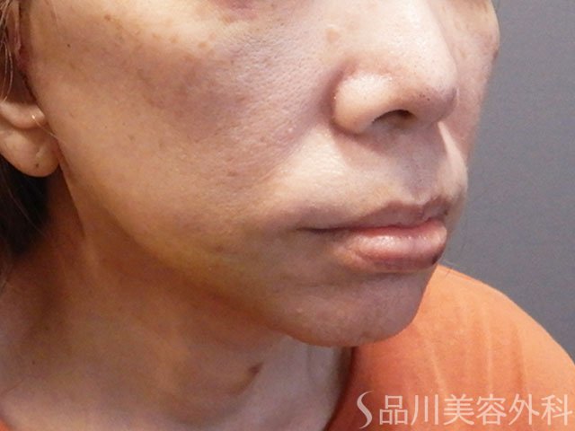 症例NO.72187のAFTER写真