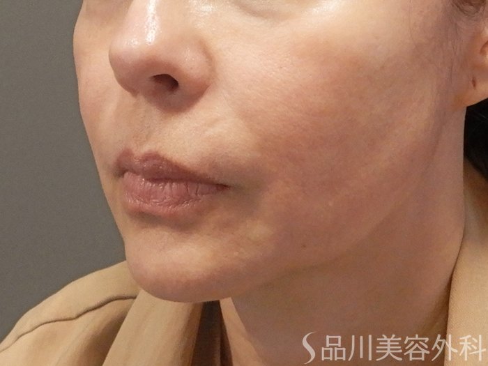 症例NO.71669のBEFORE写真
