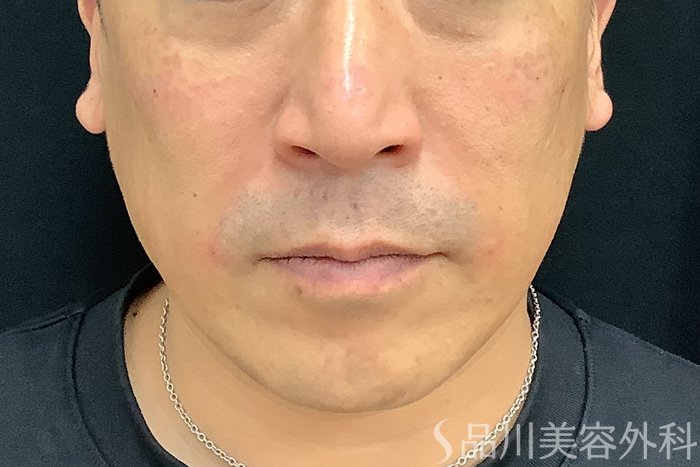 症例NO.71214のAFTER写真