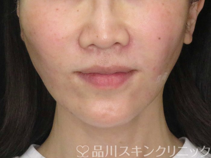 症例NO.65063のAFTER写真