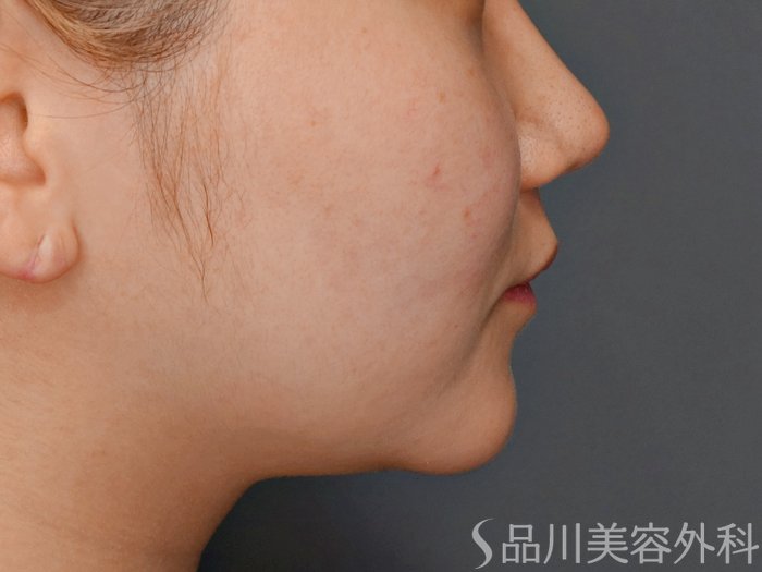 症例NO.73285のBEFORE写真