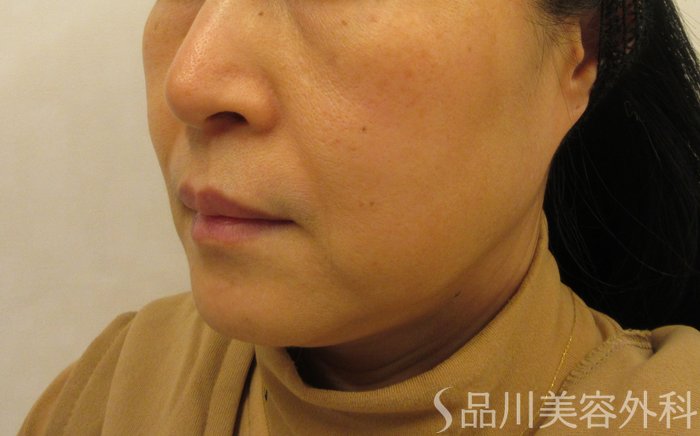 症例NO.73700のBEFORE写真