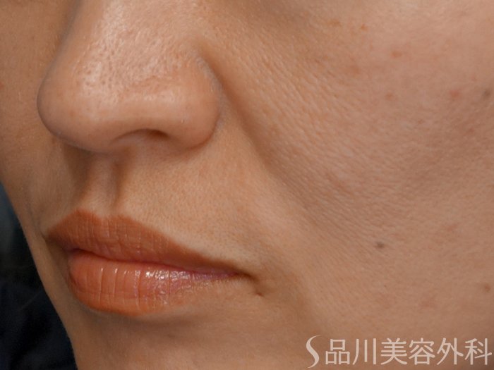 症例NO.67912のBEFORE写真