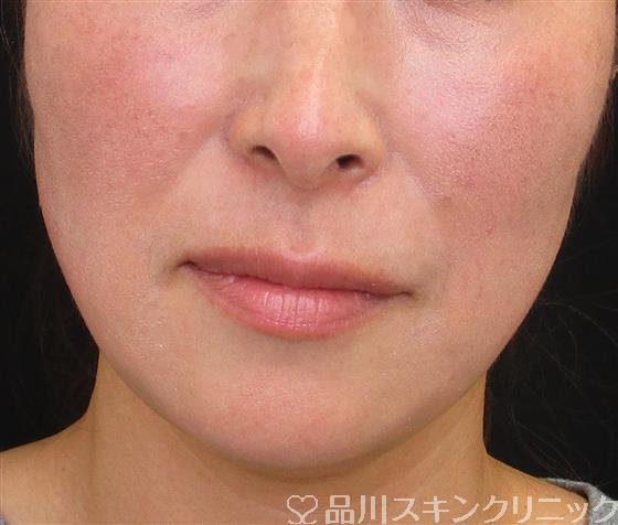 症例NO.58120のAFTER写真
