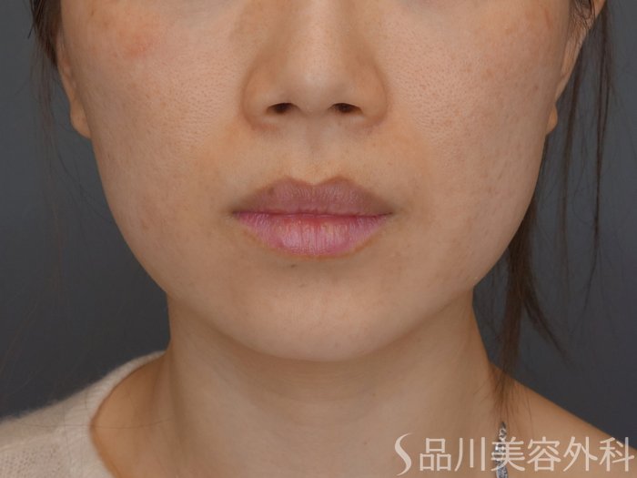 症例NO.72791のBEFORE写真