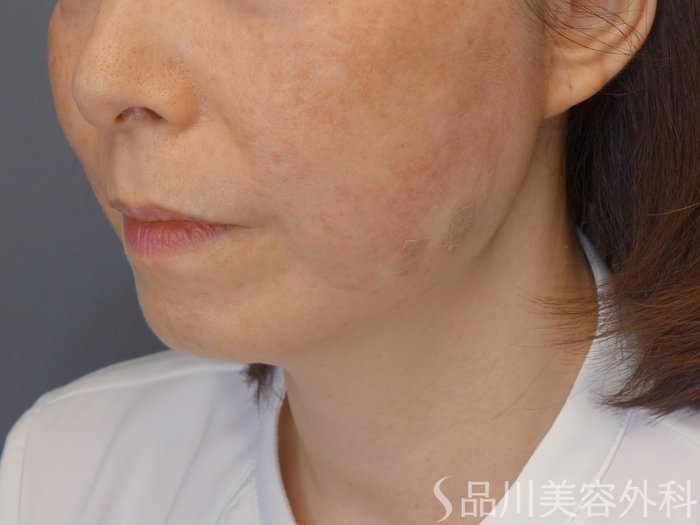 症例NO.72140のAFTER写真