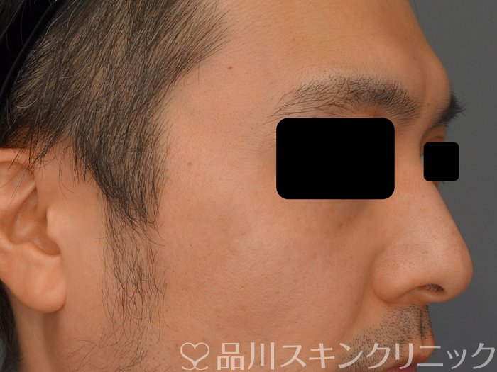 症例NO.74289のAFTER写真