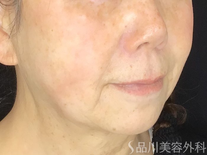 症例NO.66277のBEFORE写真