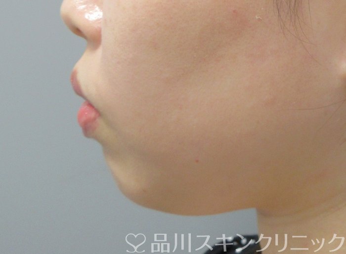 症例NO.70805のBEFORE写真