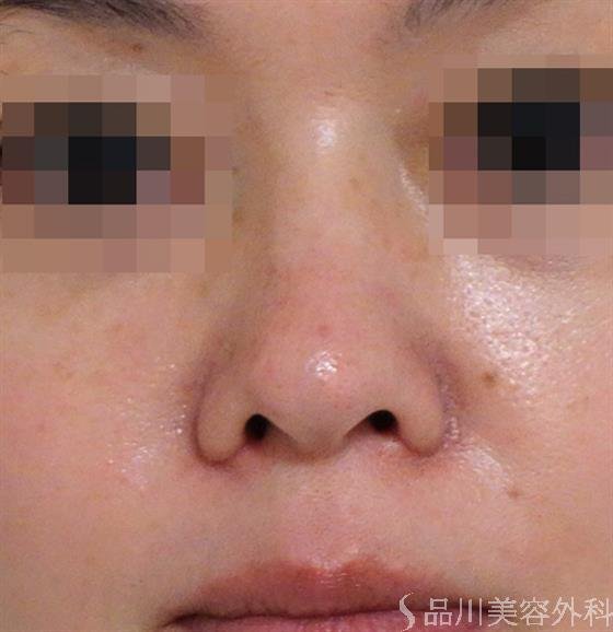 症例NO.38088のAFTER写真
