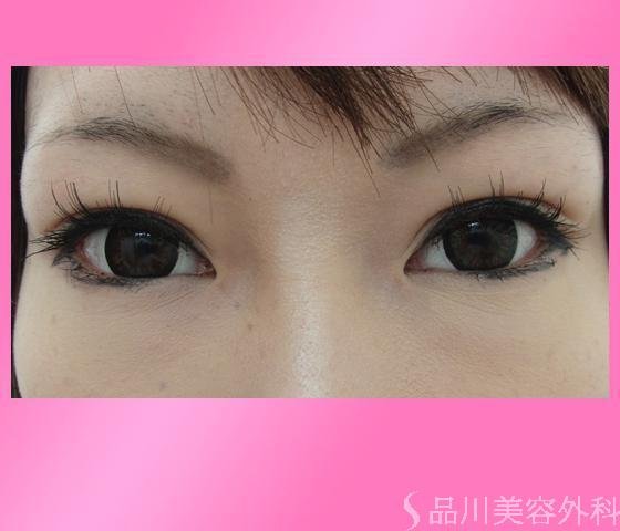 症例NO.3004のAFTER写真