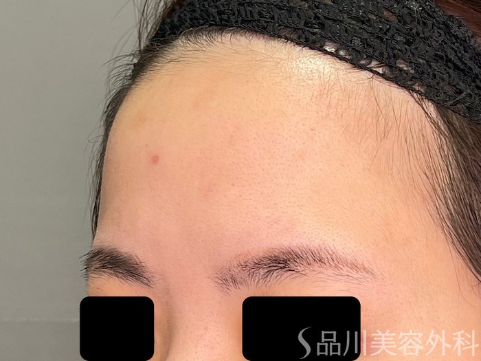 症例NO.71423のBEFORE写真