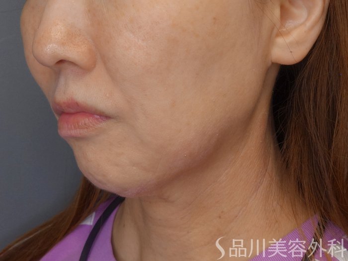 症例NO.71890のBEFORE写真