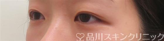 症例NO.58395のBEFORE写真