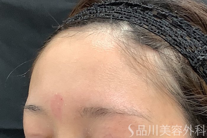 症例NO.71235のBEFORE写真