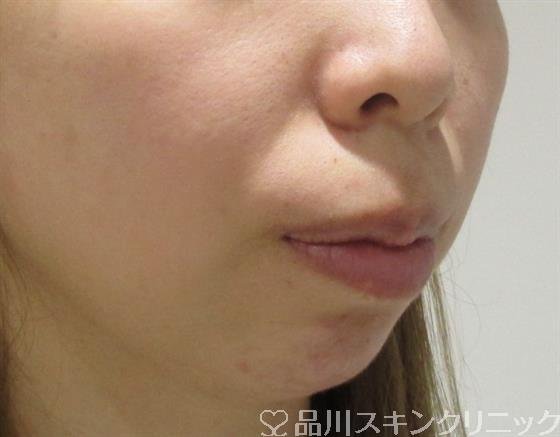 症例NO.35557のBEFORE写真