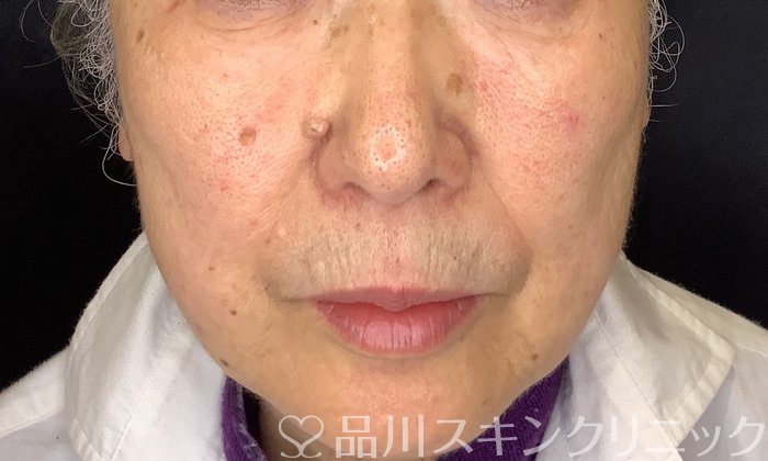 症例NO.74855のBEFORE写真