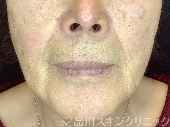 症例NO.65129のBEFORE写真