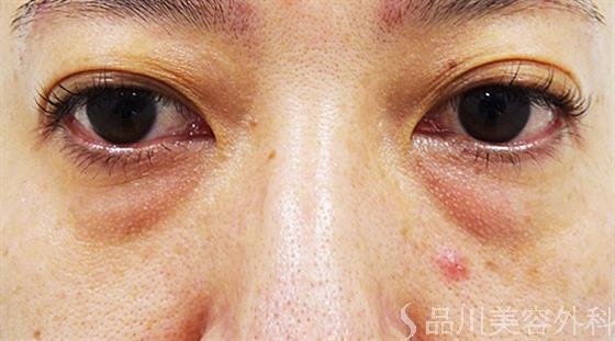 症例NO.48951のBEFORE写真