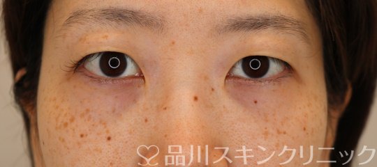 症例NO.62739のBEFORE写真