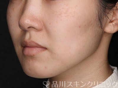 症例NO.71569のBEFORE写真