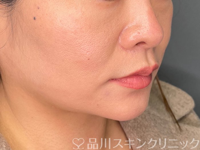 症例NO.73773のAFTER写真