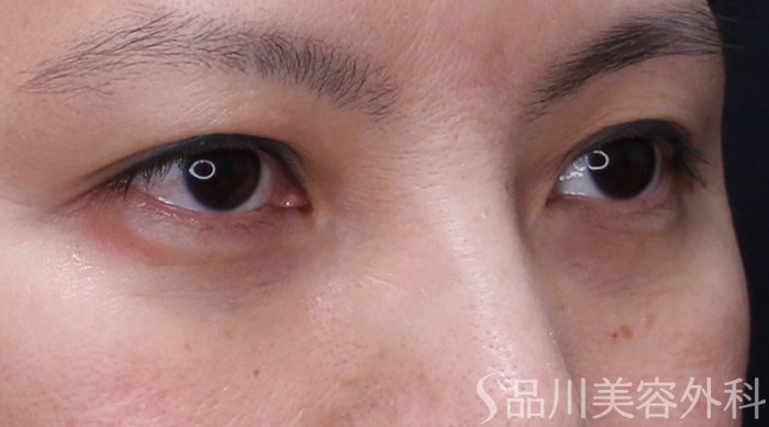 症例NO.71037のBEFORE写真