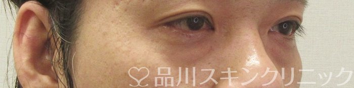 症例NO.71038のBEFORE写真