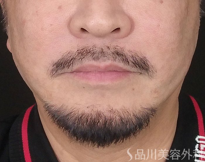 症例NO.67710のAFTER写真